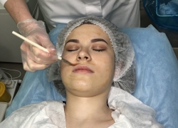 Поверхностный пилинг на основе фруктовых кислот.